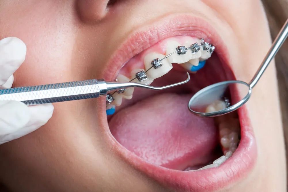 Orthodontics - Dentoper Fethiye